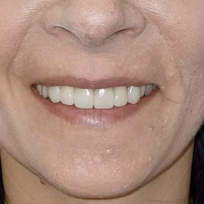 Efekt licówek, równy i naturalny uśmiech po zabiegu stomatologii estetycznej